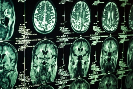 "Brain tumours are the most common cause of cancer death in children," Professor Wainwright said. 