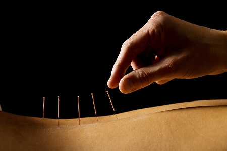 Surface irregularities and bent needle tips have not been entirely eliminated from acupuncture needles during the manufacturing process.