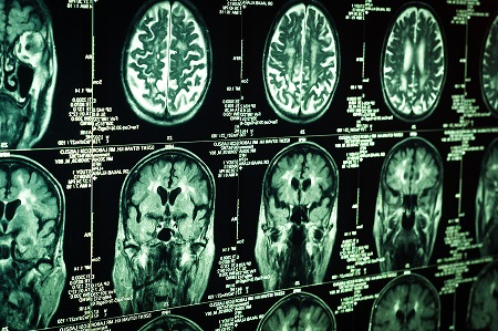 Advanced brain imaging is a critical component of a new treatment for stroke patients. (stock image)