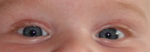 "Amblyopia is a condition in which one eye is substantially weaker than the other eye, typically detected early in childhood."