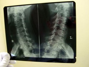 About 9000 Australians live with disabilities caused by spinal cord damage, with road accidents causing nearly half of such injuries in Australia.