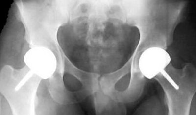 "Traditional hip implants with metal on polyethylene or ceramic on polyethylene bearing surfaces are associated with low revision rates."