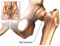 Hip Fractures can be devastating...