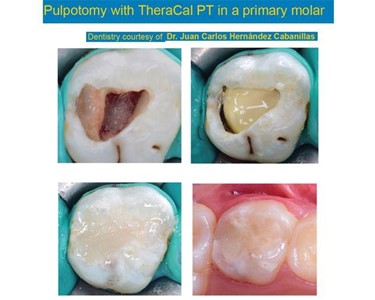 Bisco - Pulpotomy Treatment 4gm | TheraCal PT