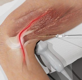 How to Perform an IPACK Block with Ultrasound How to Perform an IPACK Block with Ultrasound