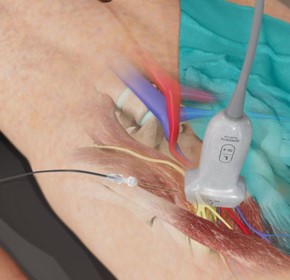 How to Perform a Femoral Block How to Perform a Femoral Block