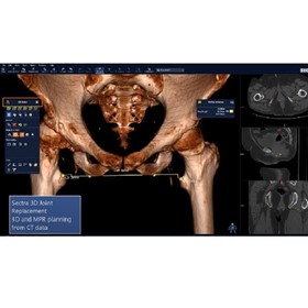 3D Imaging System | 3D Joint Replacement