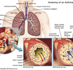 Mystery of How Eating Causes Asthma Attacks Mystery of How Eating Causes Asthma Attacks
