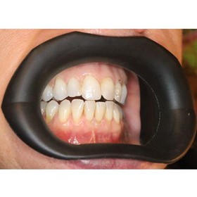 Mouth Retractor | VisionButler
