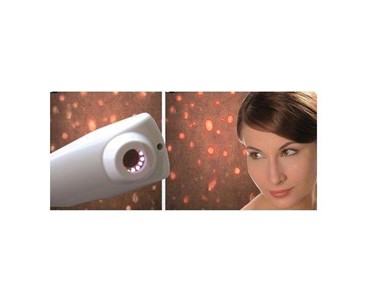 Visiopor PP 34 N - Showing Acne Bacteria Activity | Skin Analyser