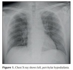 Point-of-Care Lung Ultrasound findings in novel coronavirus disease-19 pnemoniae Point-of-Care Lung Ultrasound findings in novel coronavirus disease-19 pnemoniae