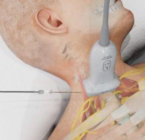 How to Perform an Interscalene Block How to Perform an Interscalene Block