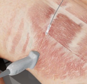 How to Perform a Tap Block with Ultrasound How to Perform a Tap Block with Ultrasound