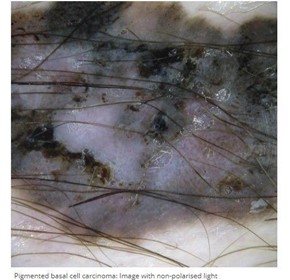 Contact And Non-contact Dermatoscopy Contact And Non-contact Dermatoscopy