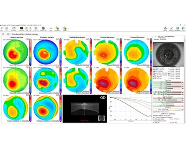 CSO - Anterior Segment OCT | MS-39 | Corneal Topography & Tomography