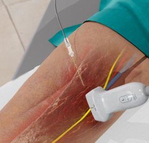 How to Perform an Adductor Canal Block How to Perform an Adductor Canal Block