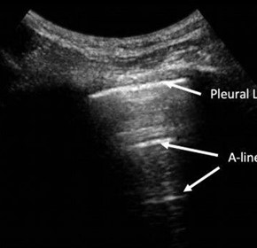 COVID-19 Lung Ultrasound COVID-19 Lung Ultrasound