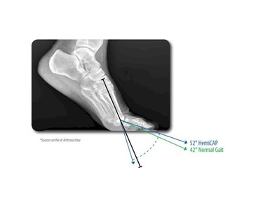 Arthrosurface - Orthopaedic Devices I HemiCAP DF Toe