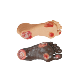 Elderly Pressure Ulcer Foot | Mentone Educational