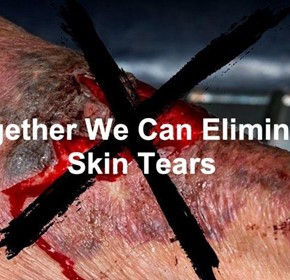Skin tears can have serious consequences for patients with frail skin Skin tears can have serious consequences for patients with frail skin