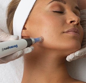 MicroNeedling: Ancient Wisdom...Meets Modern Technology MicroNeedling: Ancient Wisdom...Meets Modern Technology