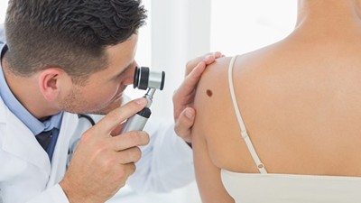 Why some moles become melanoma still a mystery