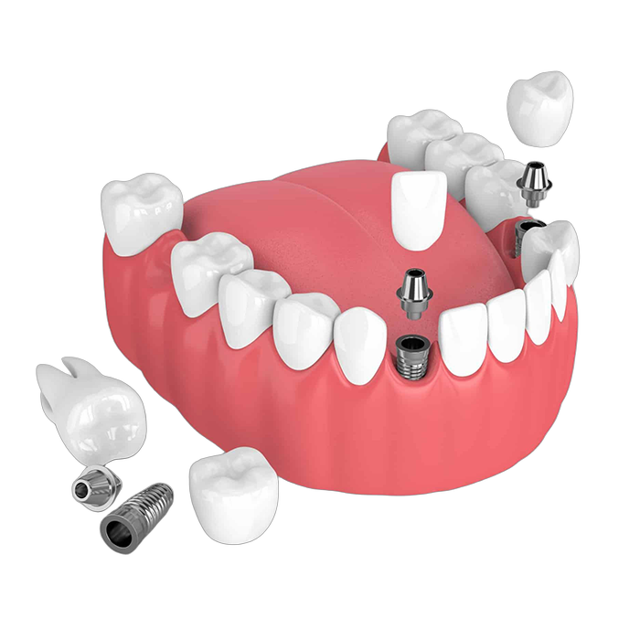 Dental Implant