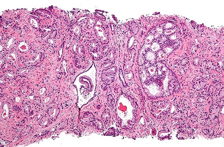 A micrograph showing prostatic acinar adenocarcinoma, the most common form of prostate cancer.