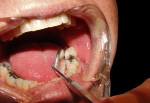 Patients with neuropathic pain often attend the dentist complaining of pain in a tooth.