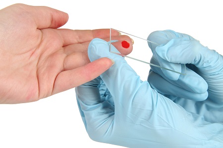 Rapid HIV testing involves either a simple finger prick or saliva swab, the results of which can be made available within 20 mins.
