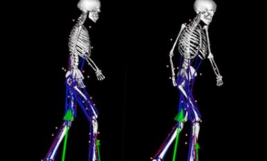 'Virtual' changes can identify if particular treatments will improve a patient's ability to move more freely. (Image: UQ)