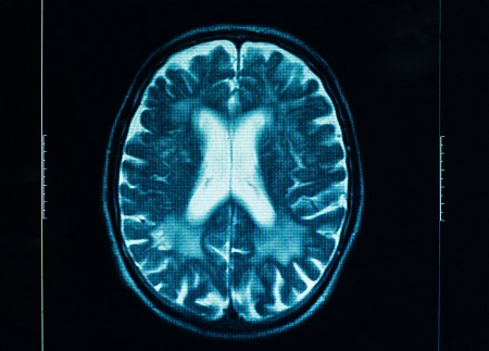 Two compounds may allow specialists greater control over swelling following a traumatic brain injury.