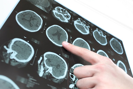 "If you deliver better care through stroke and neurosurgical units, you can reduce mortality."