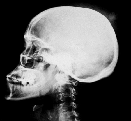 3D printing speeds up bone replacement for damaged skulls