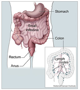 The study confirmed the increased risk of cancers already known to be associated with Lynch syndrome, including colon, uterus, ovary, kidney, stomach, and bladder cancers. 