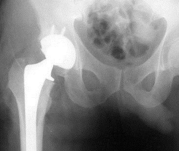  "Results show that the incidence of cancer diagnosis is low after hip replacement and lower than that predicted for the age and sex matched general population."