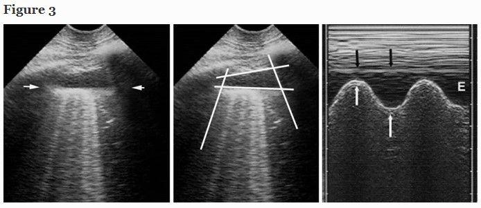 Lung Ultrasound In The Critically Ill