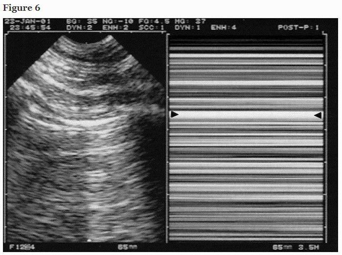 Lung Ultrasound In The Critically Ill