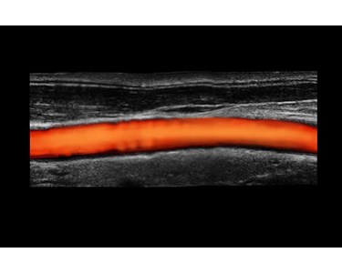 SonoScape - P50 Trolley Color Doppler Ultrasound System