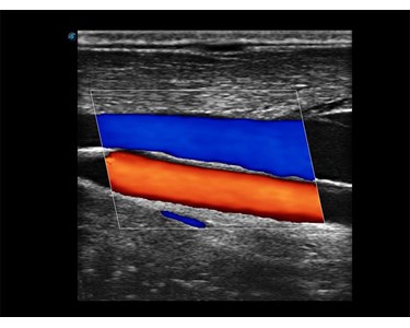 SonoScape - E3 Portable Color Doppler Ultrasound System