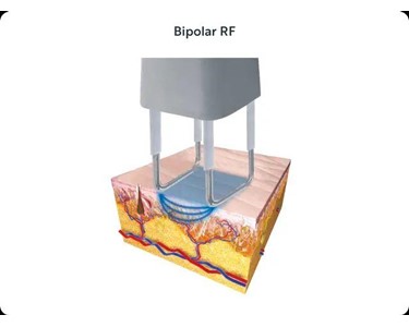 Deka - Advanced CO2 Laser | SmartXide Touch