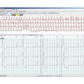 Holter Analysis Software | Holter LX - Pro