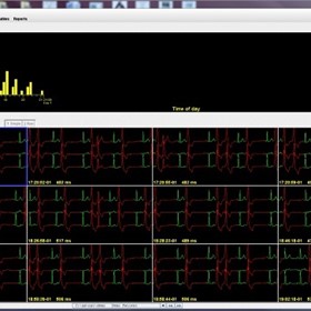 Holter Analysis Software | Holter LX - Enhanced