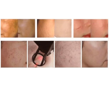 Ultrana Medical - CO2 Plus Laser | Fractional & Ablative Laser