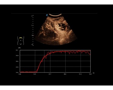 SonoScape - P60 Trolley Color Doppler Ultrasound System