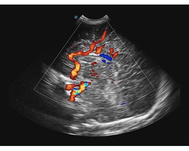 SonoScape - E3 Portable Color Doppler Ultrasound System