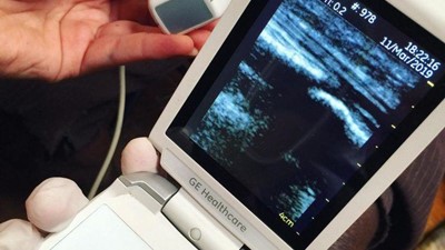 Expanding access to health care in Papua New Guinea with handheld ultrasound