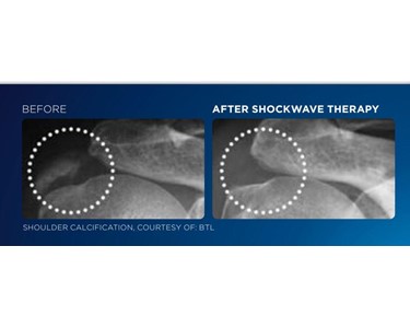 BTL - Focused Shockwave Therapy | BTL-6000 FSWT