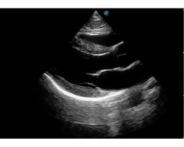 SonoScape - P20 Trolley Color Doppler Ultrasound System