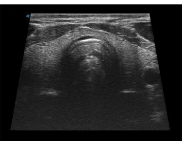 SonoScape - E1 B/W Portable Ultrasound